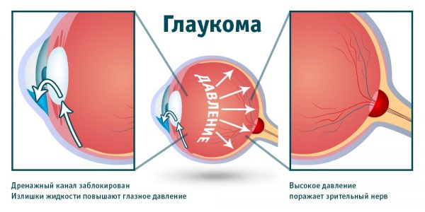 Кольцо вейса офтальмология фото